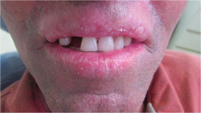 Co-existence of cheilitis glandularis and actinic cheilitis—an update |  SpringerLink