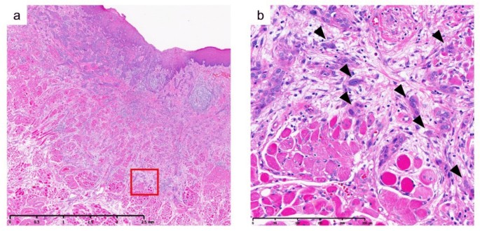 Prognostic significance of tumor budding in early oral tongue squamous ...