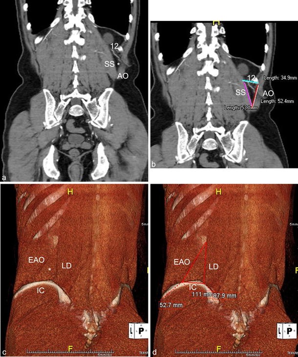 Inferior lumbar triangle, Radiology Reference Article