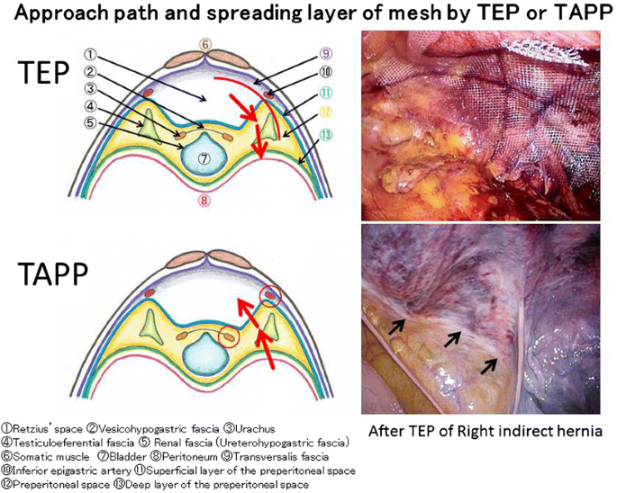 Paradigm Shift Regarding The Transversalis Fascia Preperitoneal Space And Retzius Space Springerlink