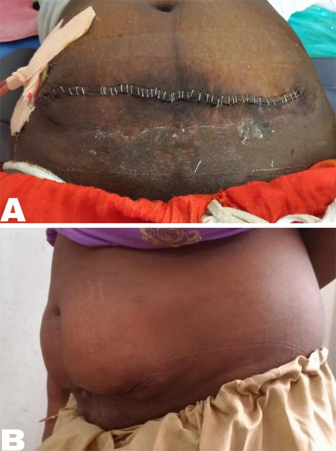 Herniation of gravid uterus through an incisional hernia with skin defect  and uterine scar dehiscence | SpringerLink