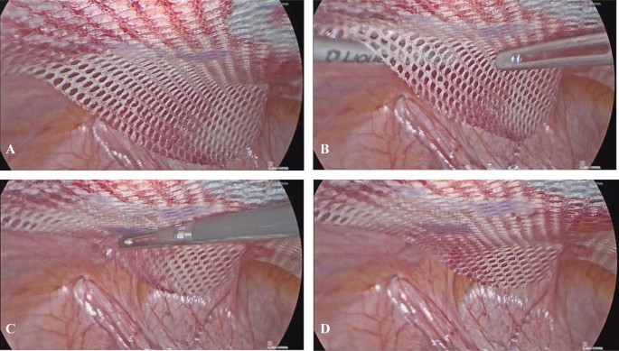 Laparoscopic intraperitoneal onlay mesh (IPOM) repair using  n-butyl-2-cyanoacrylate (Liquiband Fix8™) for mesh fixation: learning  experience and short-medium term results | SpringerLink