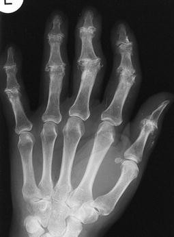 Indikation Zur Fingermittelgelenkendoprothetik Bei Patienten Ohne Rheumatische Erkrankung Springerlink