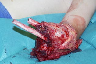 Amputationen An Der Oberen Extremitat Springerlink