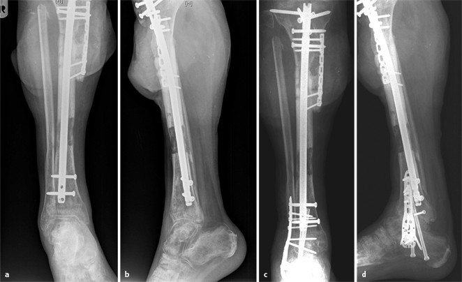 Arthrodesen Am Sprunggelenk Und Ruckfuss Springerlink 