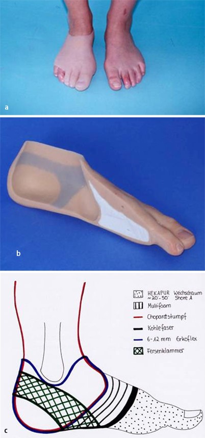 Orthopädische Versorgung nach Fußverletzungen | Trauma und Berufskrankheit