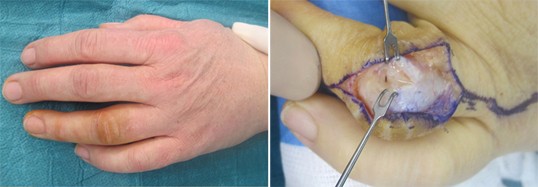 Infektionen nach sogenannten Bagatellverletzungen der Hand | Trauma und  Berufskrankheit | Springer Nature Link