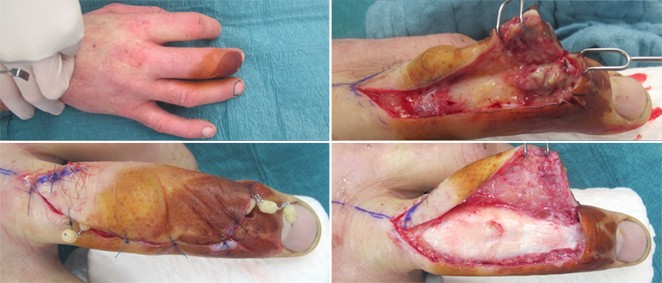 Infektionen nach sogenannten Bagatellverletzungen der Hand | SpringerLink