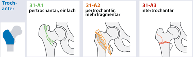 Proximale Femurfraktur Und Insuffizienzfrakturen Im Alter Springerlink