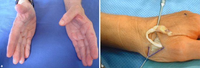 Spezielle Verletzungen der Strecksehnen an der Hand | SpringerLink