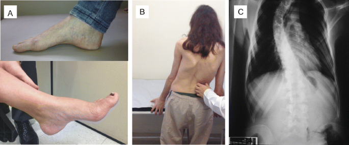 اعوجاج العمود الفقري مع ترنّح فريدريخ عند الأطفال
