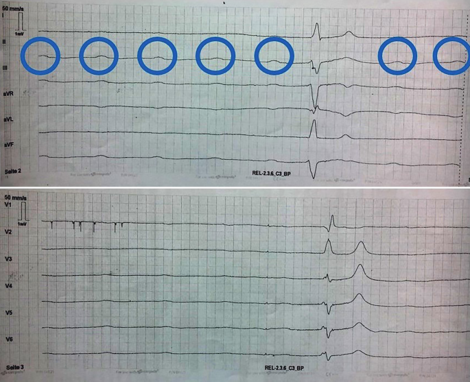 Hyperkaliamie Und Brash Syndrom In Der Notfallmedizin Springerlink
