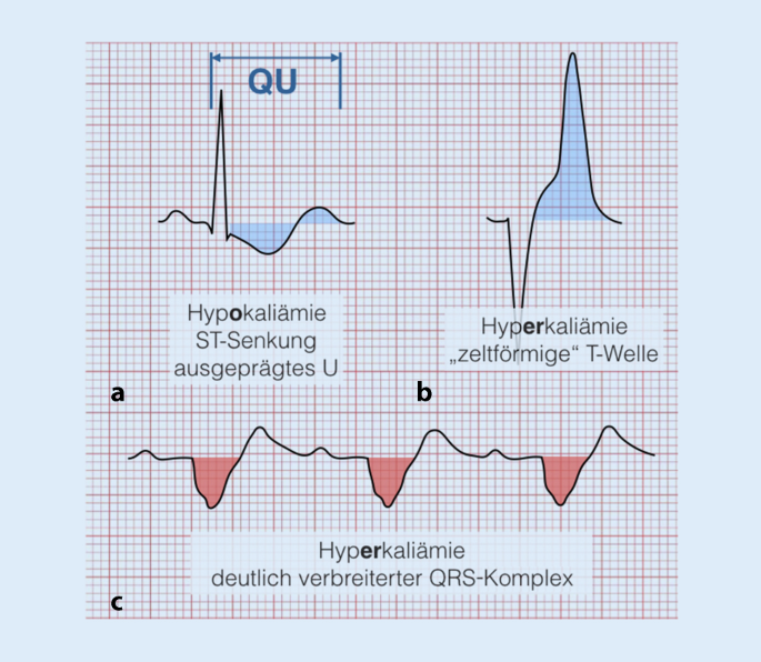 Disabilities Und Electrolytes In Der Ekg Diagnostik Springerlink