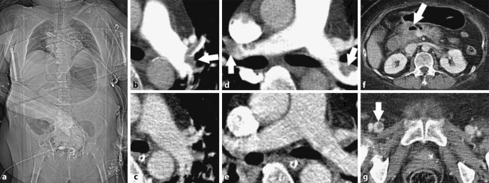 Update Polytrauma Und Computertomographie Unter Reanimationsbedingungen Springerlink