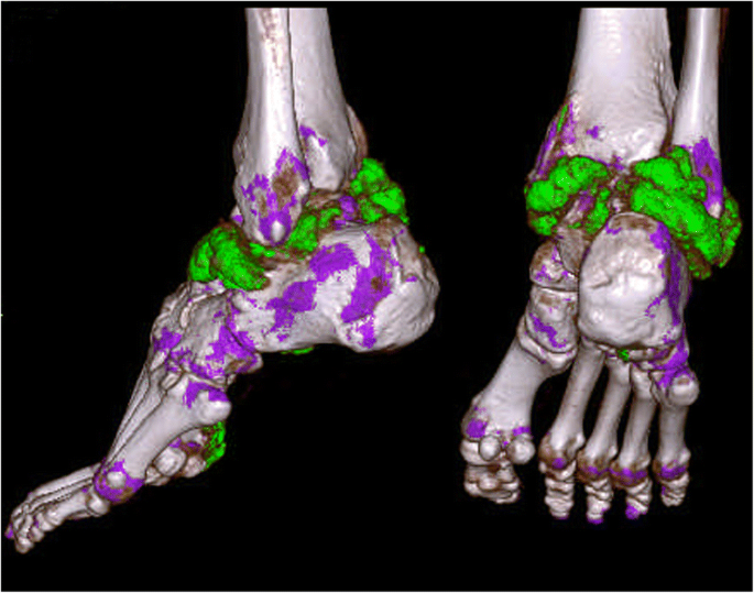 Gout of ankle and foot: DECT versus US for crystal detection | SpringerLink