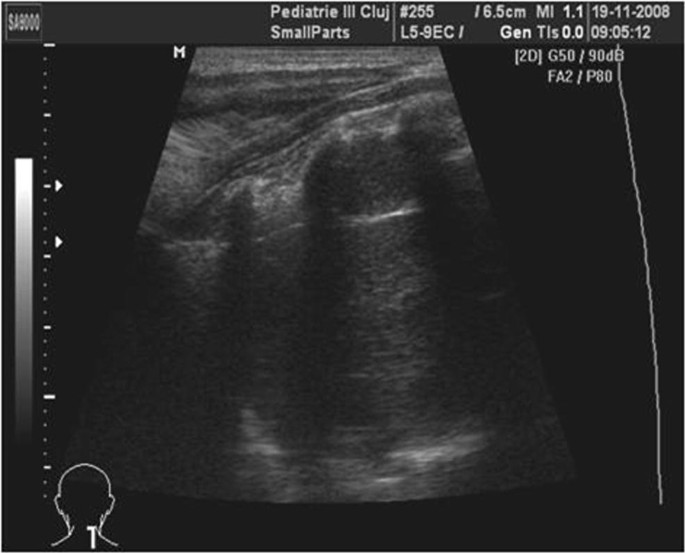 A Case Report On Ganglioneuroblastoma During Pregnancy 