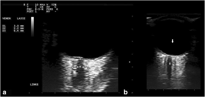 optic nerve sheath diameter