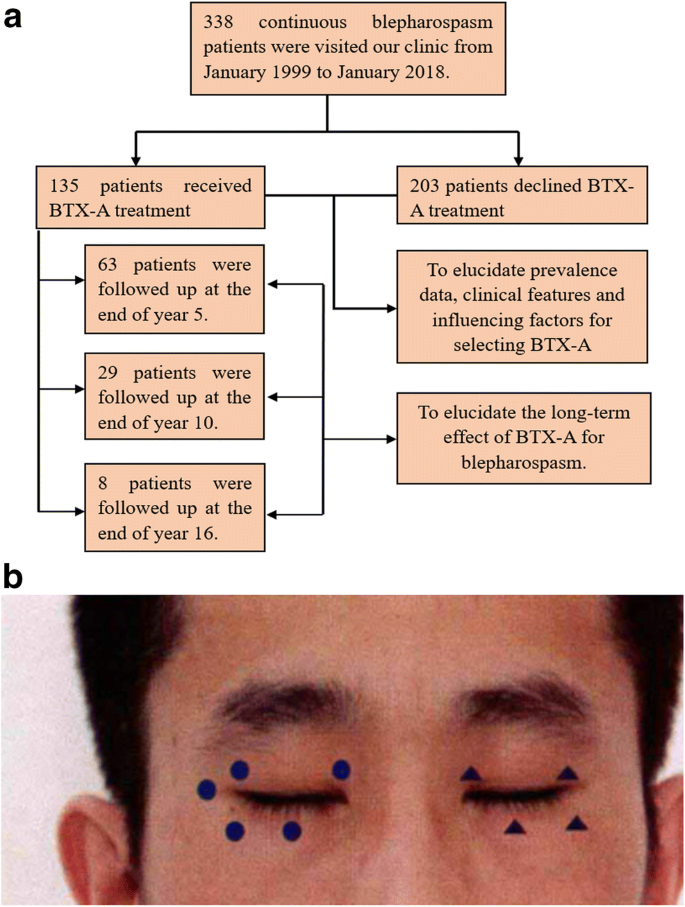 Long-term treatment of blepharospasm with botulinum toxin A: a  service-based study over a 16-year follow-up in southern China |  SpringerLink