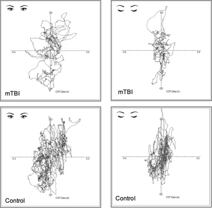 PDF) The effects of video game therapy on balance and attention in chronic  ambulatory traumatic brain injury: An exploratory study