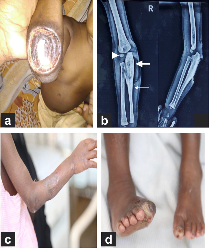 Skeletal complications in congenital insensitivity to pain and anhidrosis:  a problem to reckon with | SpringerLink