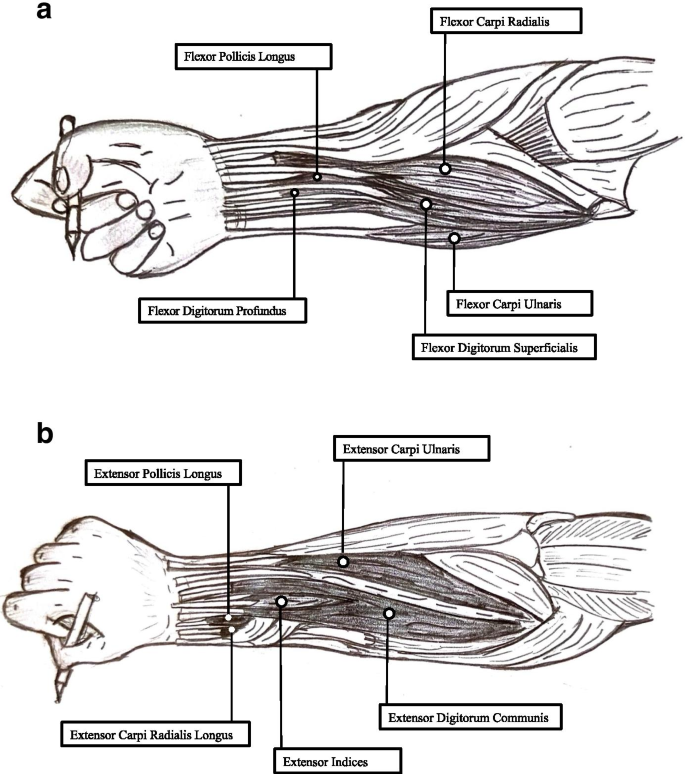 Treatment of focal hand dystonia: current status | SpringerLink