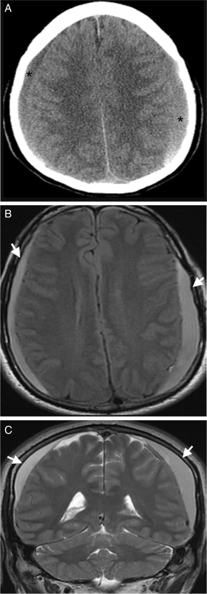 Neuroimaging in the diagnosis and treatment of intracranial pressure  disorders | Neurological Sciences