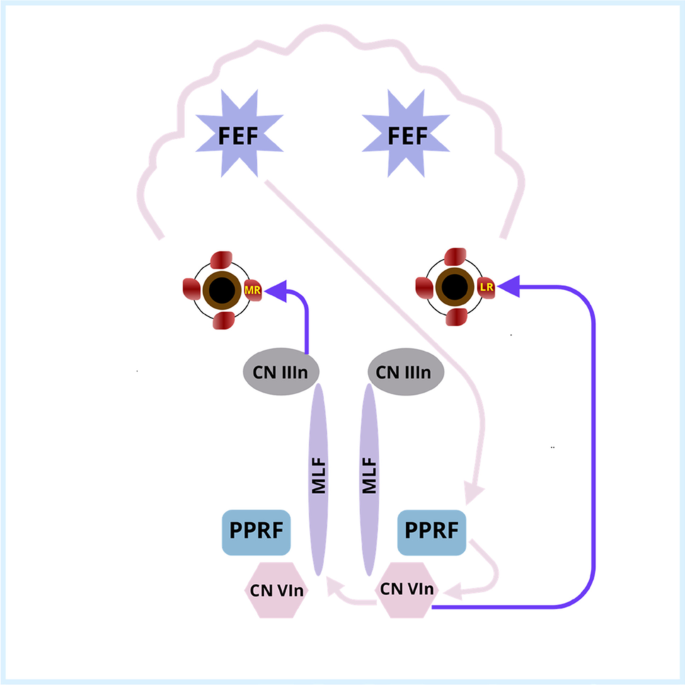 The one-and-a-half syndrome: a distinctive clinical finding ...