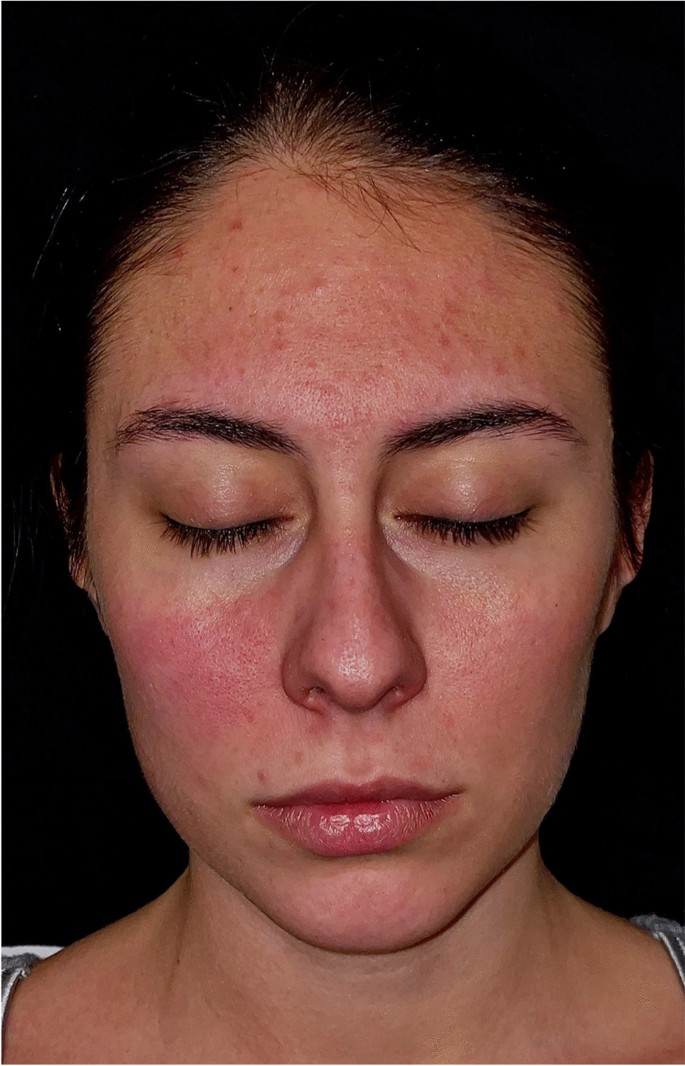 Amitriptyline induced rosacea-like rash | Neurological Sciences | Springer Nature Link Amitriptyline induced rosacea-like rash | Neurological Sciences | Springer Nature Link