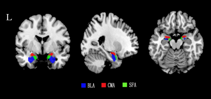 Aberrant functional connectivity of amygdala subregions in temporal ...