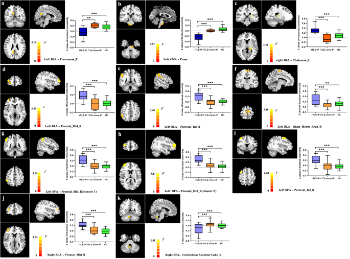 Aberrant functional connectivity of amygdala subregions in temporal ...