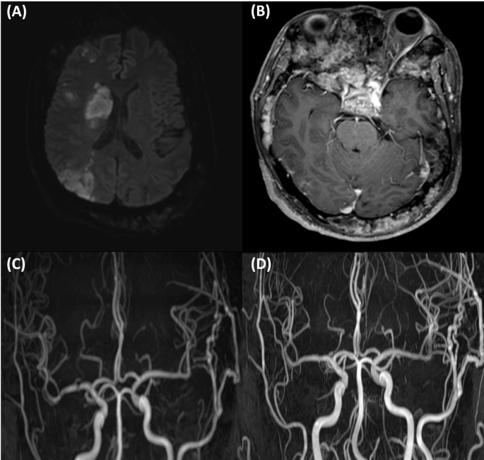 Acute cerebral infarction in a patient with Paget`s disease ...