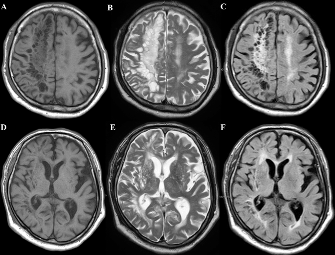 Swiss cheese brain presenting as corticobasal syndrome Neurological