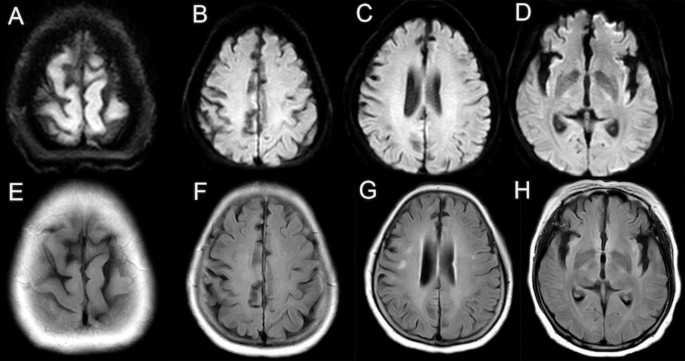 Cortical ribbon sign in AMPAR antibody-associated encephalitis ...