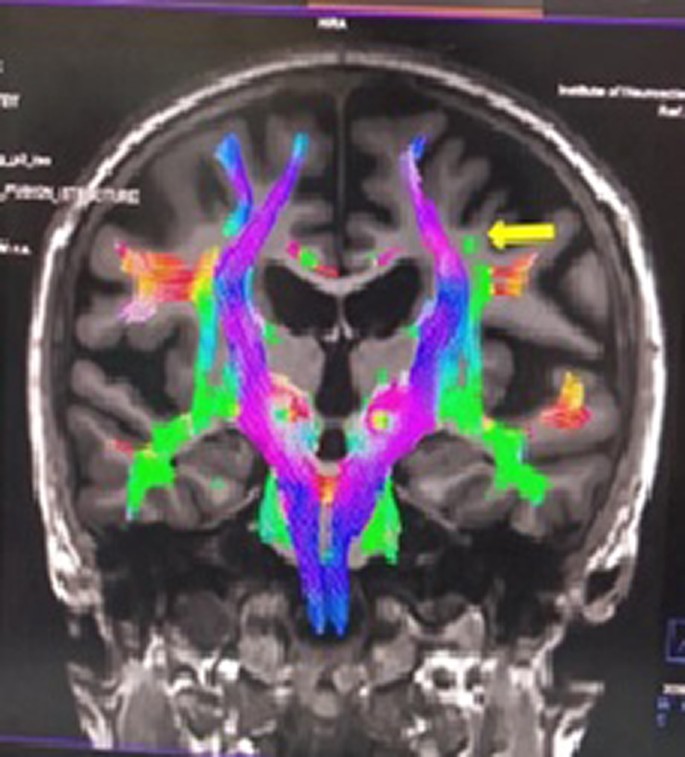 Neuroradiological insights into primary progressive apraxia of speech