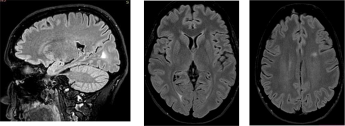 Unraveling X-linked adrenoleukodystrophy in women: a rare case of ...