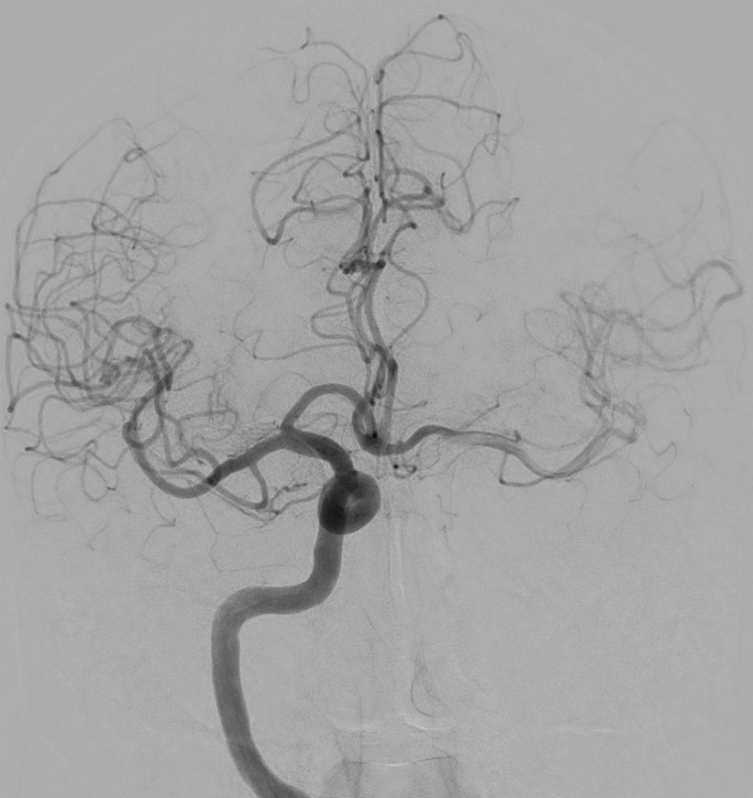 Multichannel internal carotid artery: congenital or acquired pattern ...