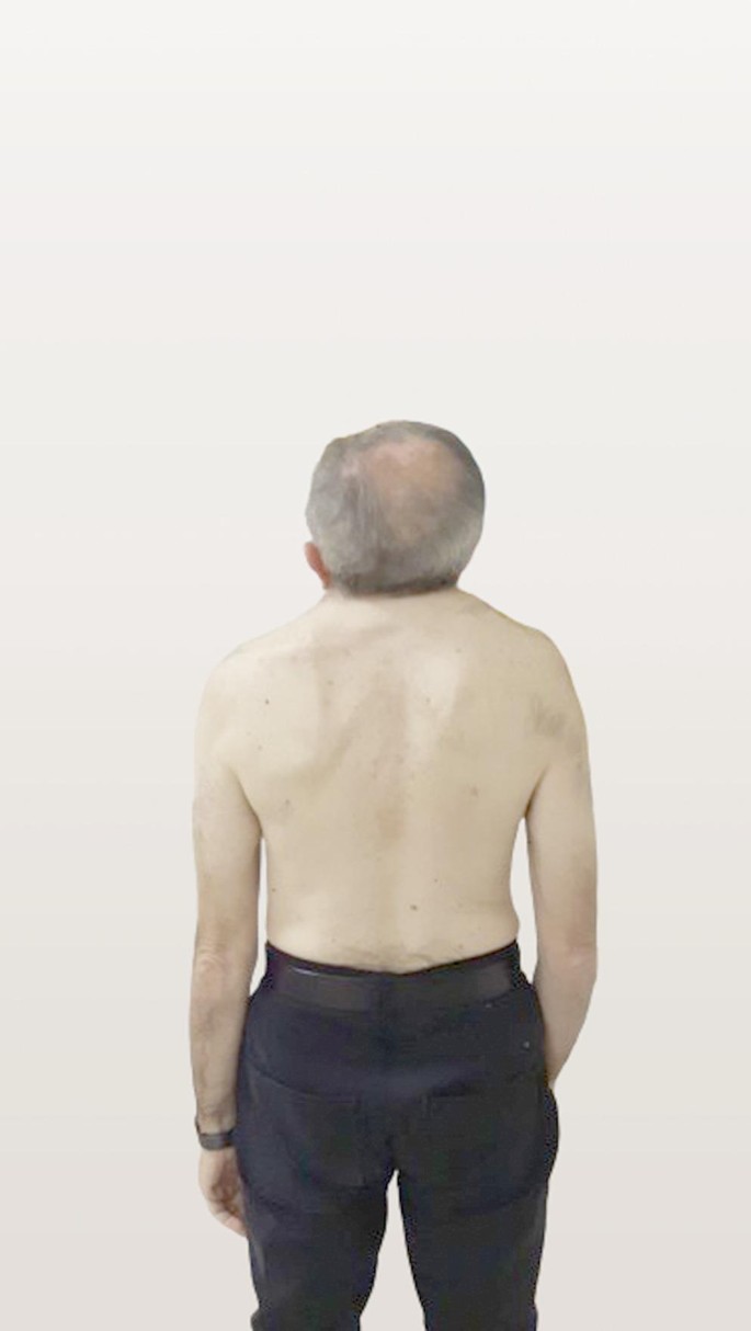 Diastematomyelia and the Klippel-Feil Syndrome, image size:685x1214