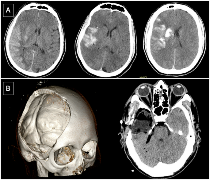 CT hyperdensities after recanalization for anterior circulation large ...