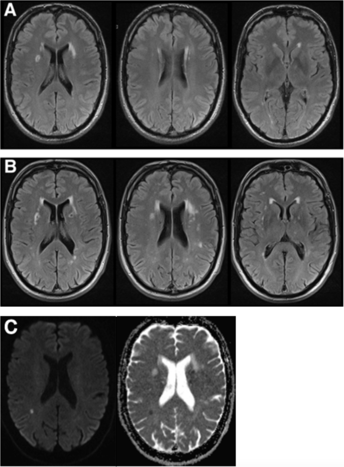 Novel COL4A2 splice-site variant associated with cerebral small vessel ...