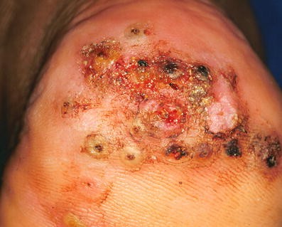 Tungiasis (sand flea disease): a parasitic disease with particular  challenges for public health