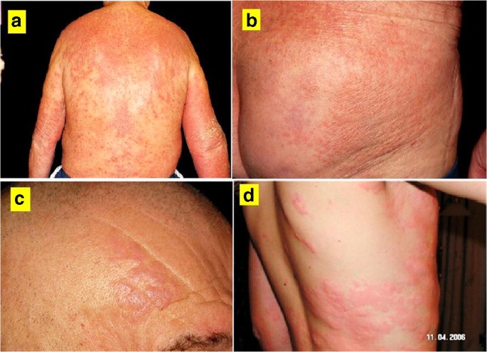 giardia skin manifestations