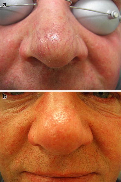 Using the ultra-long pulse width pulsed dye laser and elliptical spot to  treat resistant nasal telangiectasia | SpringerLink