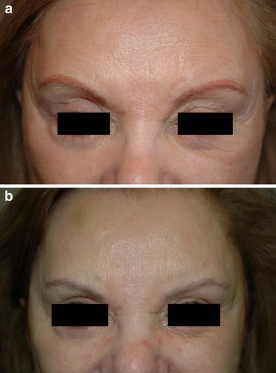 Removal of orange eyebrow tattoo in a single session with the Q-switched Nd:YAG 532-nm laser | SpringerLink Removal of orange eyebrow tattoo in a single session with the Q-switched Nd:YAG 532-nm laser | SpringerLink