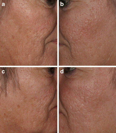 Fractional nonablative 1,540-nm laser resurfacing of atrophic acne scars. A  randomized controlled trial with blinded response evaluation | SpringerLink