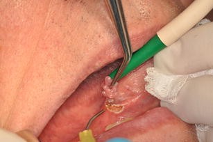 papilloma removal recovery