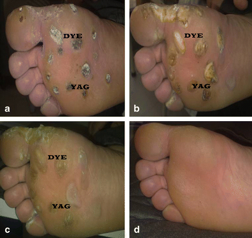 Pulsed dye laser versus Nd:YAG laser in the treatment of plantar warts: a  comparative study | SpringerLink