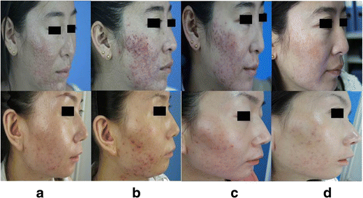 The long-term effect of 1550 nm erbium:glass fractional laser in acne  vulgaris | SpringerLink