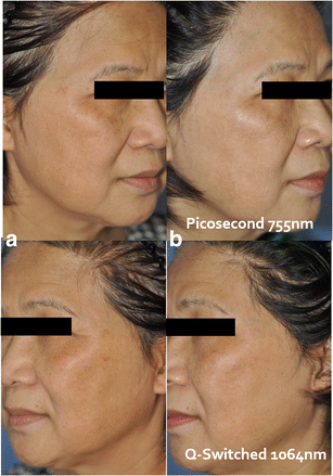 A split-face study: comparison of picosecond alexandrite laser and  Q-switched Nd:YAG laser in the treatment of melasma in Asians | SpringerLink