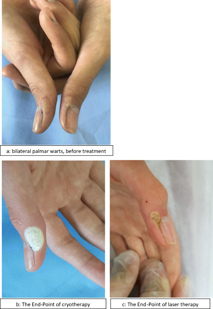 Comparison of long-pulsed Nd: YAG laser with cryotherapy in treatment of  acral warts | SpringerLink