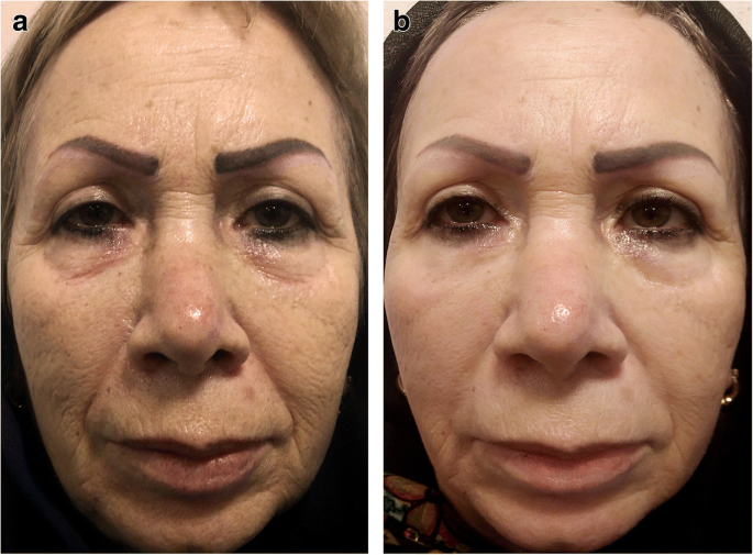 Efficacy and safety of long pulse Nd:YAG laser versus fractional erbium:YAG  laser in the treatment of facial skin wrinkles | SpringerLink
